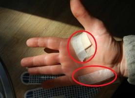 Ako zlepšiť rukavice upustiť mozole?